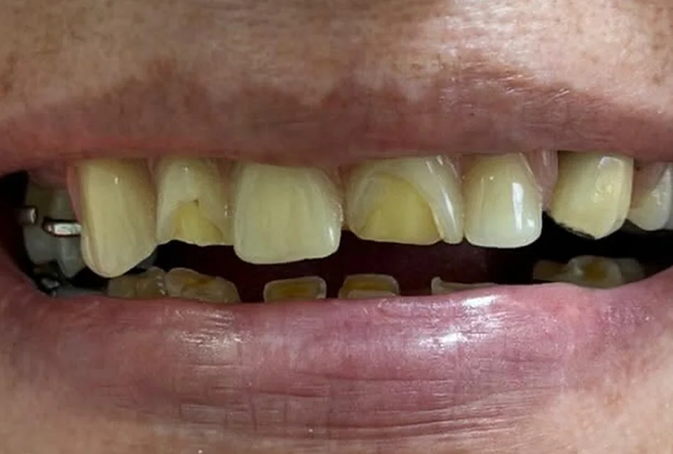 Antes: dientes frontales fracturados, desgastados y con manchas