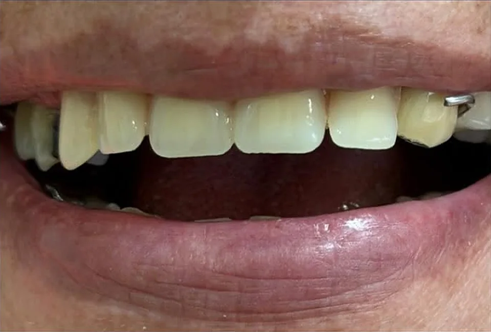 Después: sonrisa restaurada con dientes alineados y de color uniforme, tratada en Punto Dent